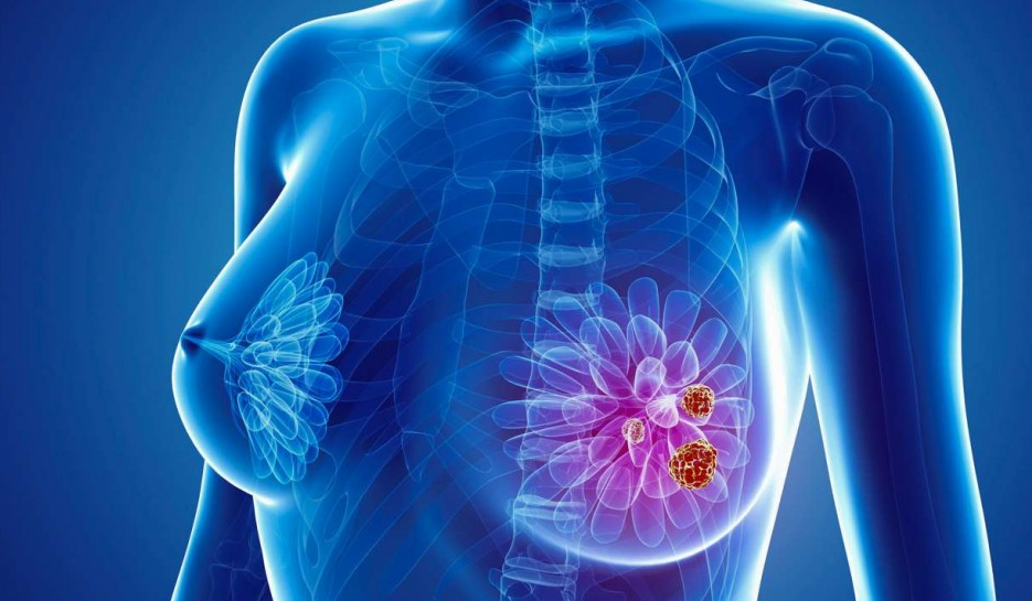 Mes del cáncer de mama: hábitos saludables, mamografías y nuevas terapias | Actualidad