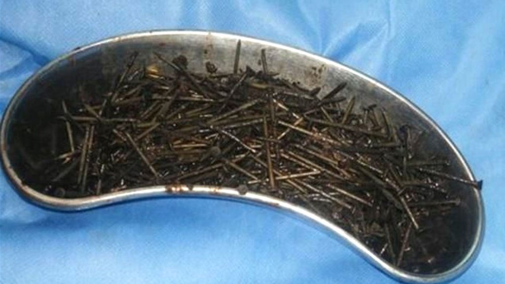 Médicos extrajeron 112 clavos del estómago de un paciente en Etiopía | Curiosidades