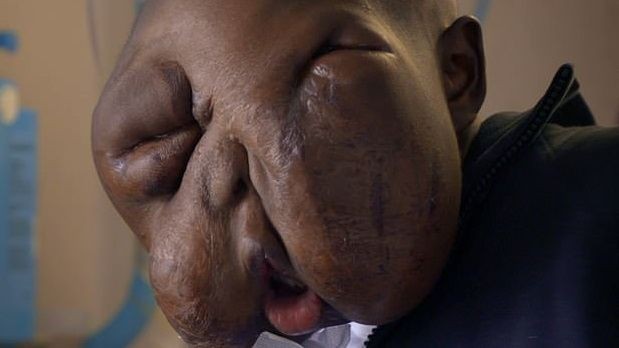 La increíble recuperación de un joven con un enorme tumor en la cara | Curiosidades