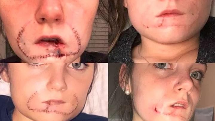 Condenaron a 12 años de prisión al hombre que le arrancó el labio a su exnovia | Internacionales