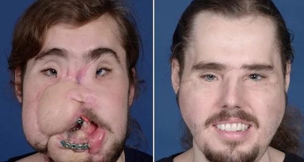 El asombroso trasplante de cara que le cambió la vida a un joven de 26 años | Curiosidades