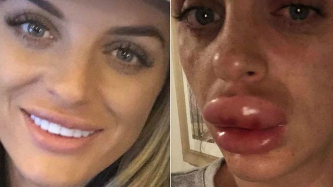 Así le quedaron los labios a una mujer tras participar de una "fiesta de botox" | Internacionales