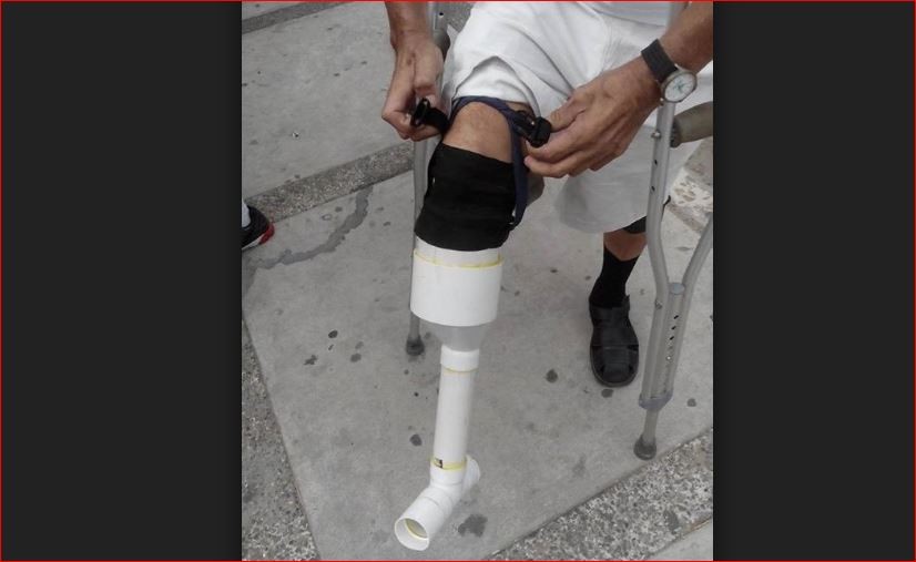 Se armó su propia prótesis para poder seguir trabajando | Redes