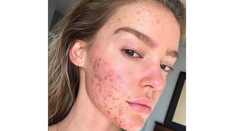 El secreto de esta joven modelo para combatir el acné de su cara | Curiosidades
