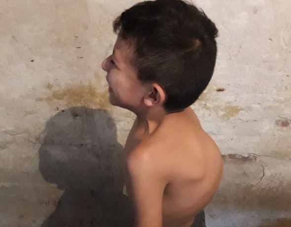 Nene con escoliosis progresiva necesita insumos para ser operado en el Garrahan | Redes