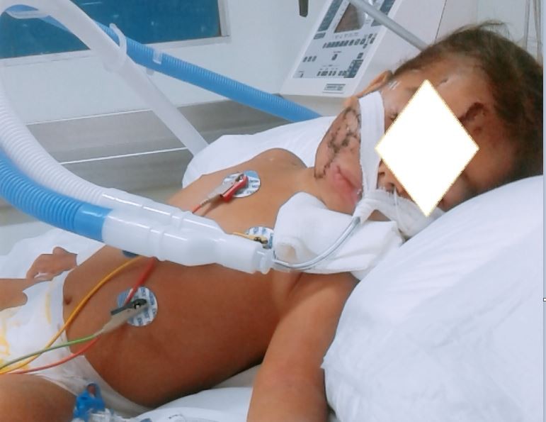 Otra nena fue atacada por un pitbull en su casa | Actualidad