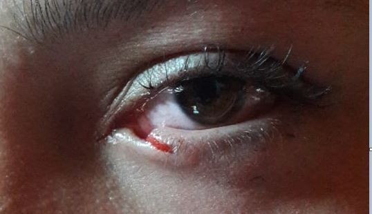 Víctima de bullying terminó con un corte en el lagrimal | Actualidad