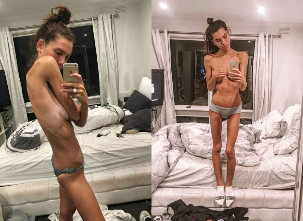 La joven que sufrió anorexia, se recuperó y ahora logró un sorpresivo cambio físico | Curiosidades