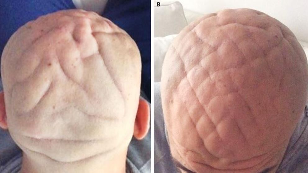 La extraña enfermedad de un hombre que tiene su cabeza con forma de cerebro | Curiosidades
