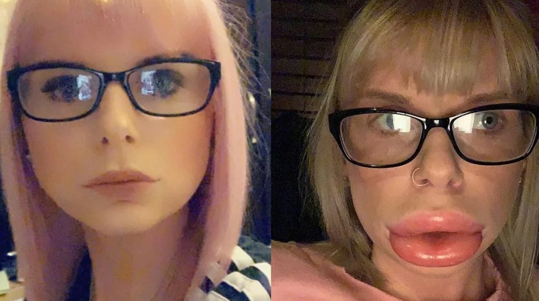 Así quedó una joven por una reacción alérgica que le causó el botox | Curiosidades