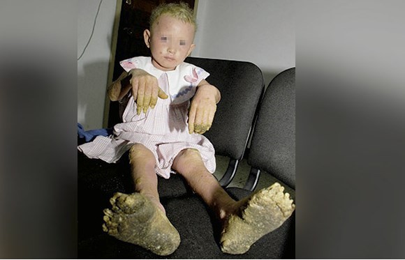 La triste historia de la primera "nena árbol" de América Latina | Curiosidades