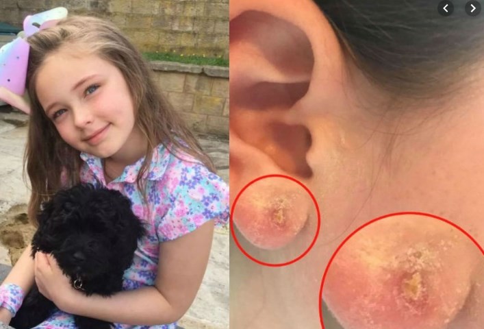 Fue a ponerle aritos a su hija de 10 años y la nena terminó internada por una infección | Curiosidades