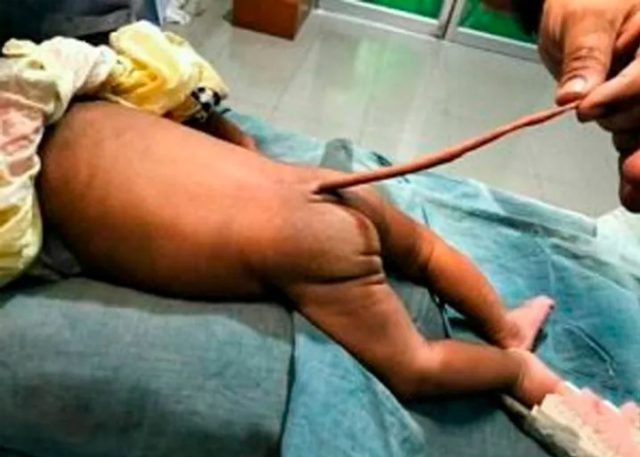 El caso del bebé que nació con una "cola de ratón" | Curiosidades