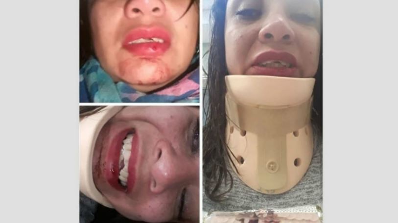 Iba a su despedida de soltera y terminó con un cuello ortopédico y los dientes rotos | Actualidad