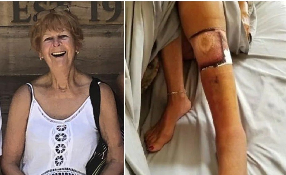 Murió una mujer tras infectarse con la bacteria "come carne" | Internacionales