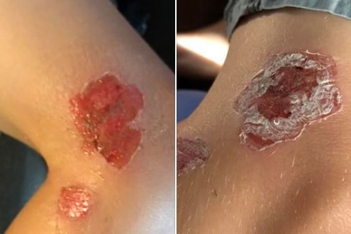 Así quedó el cuerpo de un nene tras ser atacado por la bacteria "come carne" | Internacionales