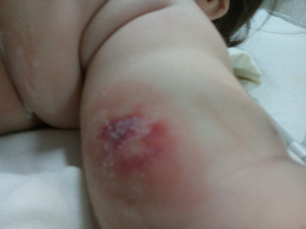 Murió una beba que habría sido quemada por error en un hospital | Actualidad