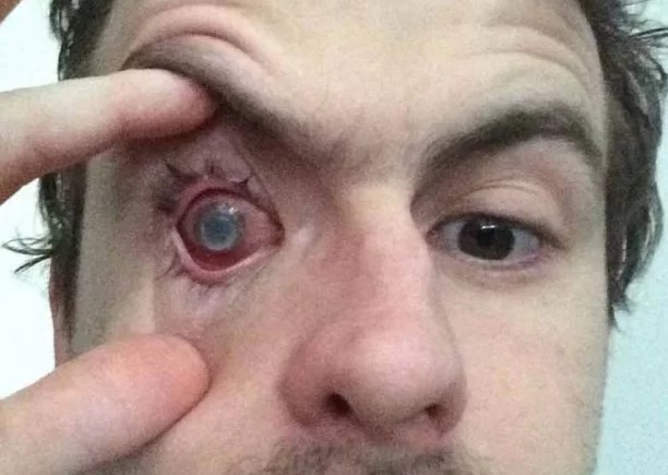 El drama de un joven inglés que se duchó con los lentes de contacto y se quedó ciego | Curiosidades