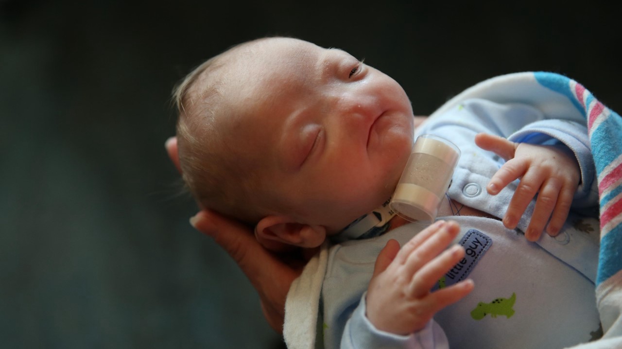 La enfermedad del nene que nació sin nariz | Actualidad