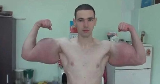 El drama del "Hulk" ruso: no soporta el dolor y quiere salvar sus brazos de la amputación | Curiosidades