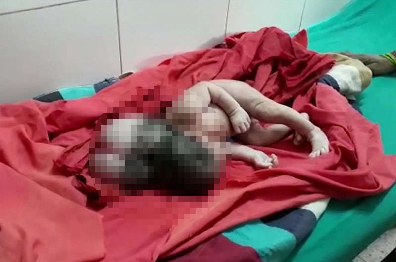 Conmoción por el nacimiento de una bebé de tres cabezas | Curiosidades