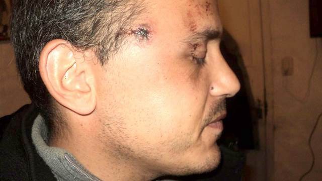 Le dispararon en un robo y vive con una bala en la cabeza | Actualidad