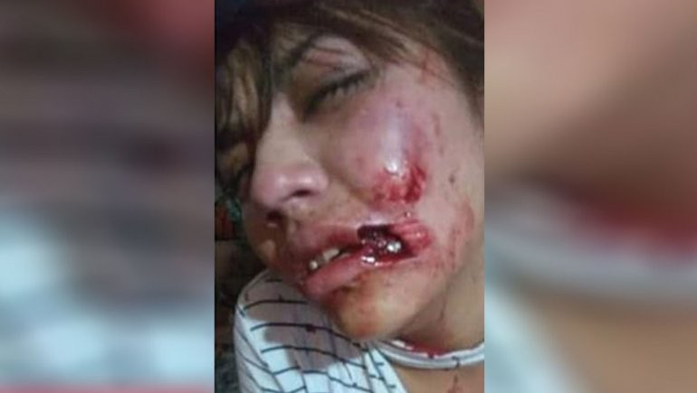 Un joven atacó a su novia y le arrancó parte del labio | Actualidad