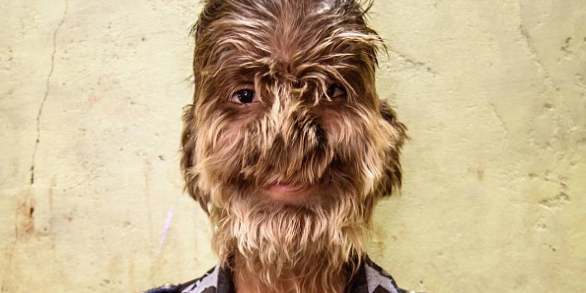 Alarma por chicos que sufren el "síndrome del hombre lobo", luego de tomar un medicamento contaminado | Internacionales