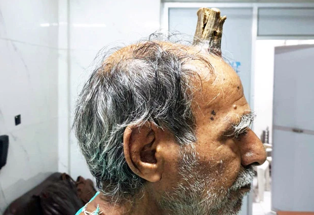 El extraño caso del hombre que le creció un "cuerno del diablo" tras un golpe en la cabeza | Curiosidades