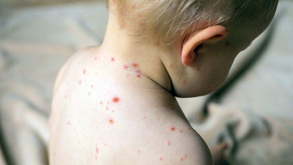 Sarampión: "9 de cada 10 personas susceptibles, cuando están en contacto con el virus, pueden infectarse" | Actualidad