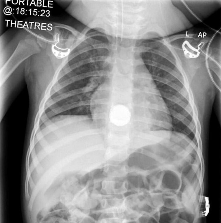 Una nena de dos años se comió una pila de litio y estuvo a punto de morir | Internacionales