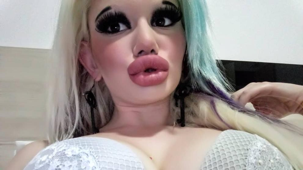 La joven que se hizo 15 cirugías para triplicar el tamaño de sus labios | Curiosidades