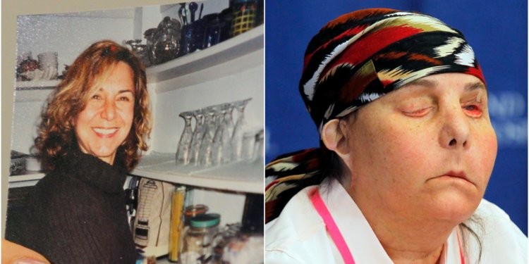 Su marido la quemó con ácido, le hicieron un trasplante de cara y ahora su cuerpo rechaza el nuevo rostro | Internacionales