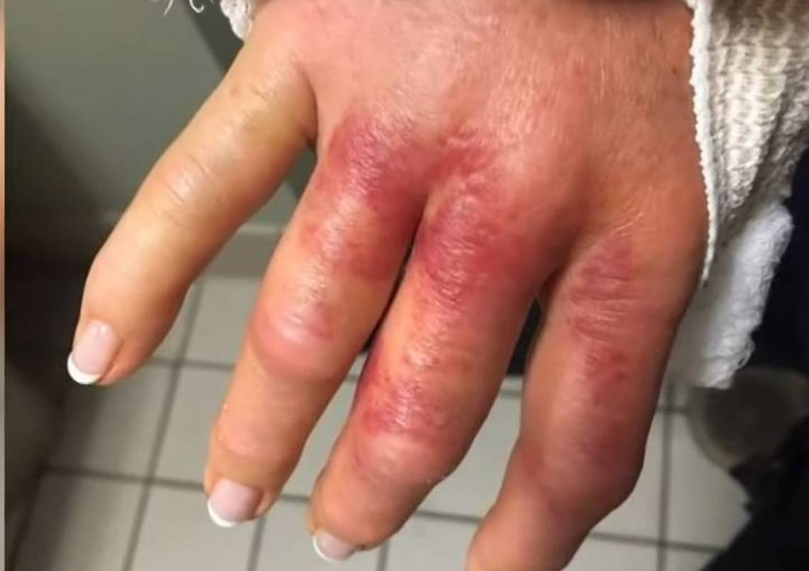 Fue por una sesión de manicura y casi pierde la mano por la bacteria "come carne" | Internacionales