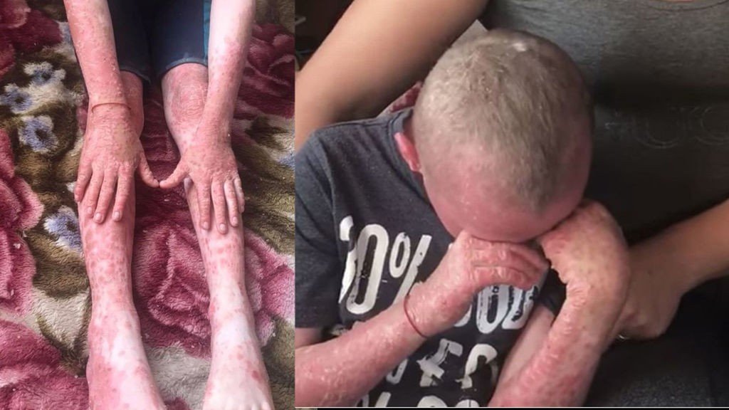 El nene que tiene una psoriasis extrema y "ya no quiere vivir" | Internacionales