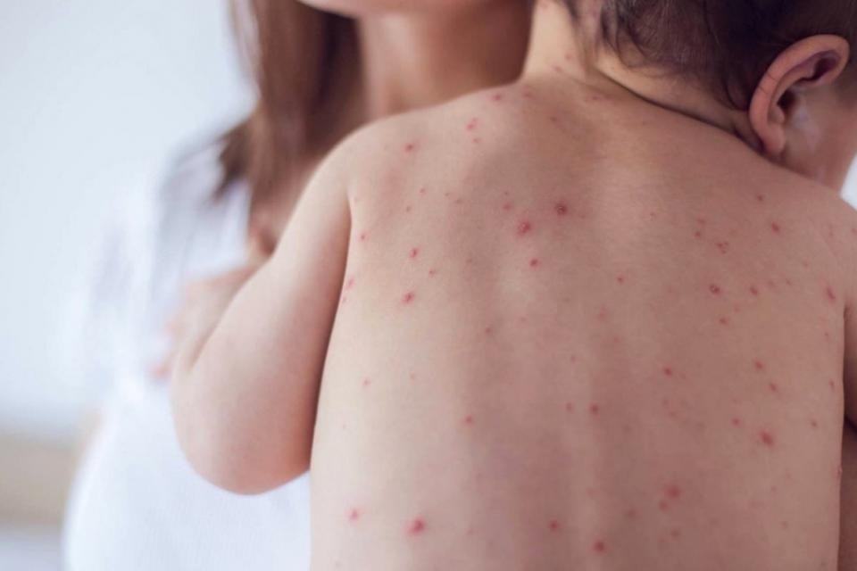 Una mujer antivacunas le contagió el sarampión a sus cinco hijos | Actualidad