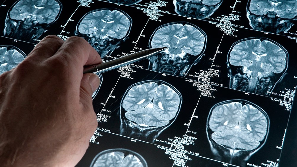 Inédito: logran frenar el Alzheimer en ratones y hay expectativa por su aplicación en humanos | Actualidad