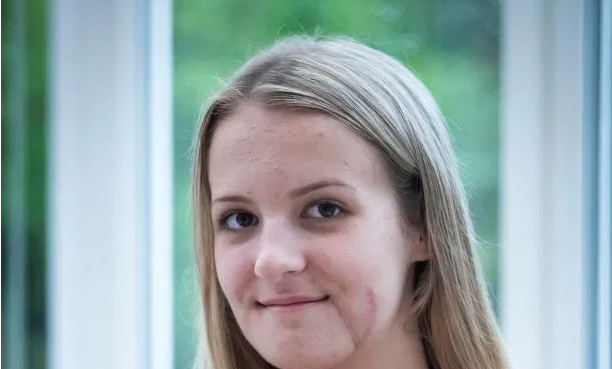 Así le reconstruyeron la cara a una joven que casi pierde la mandíbula en un accidente | Curiosidades