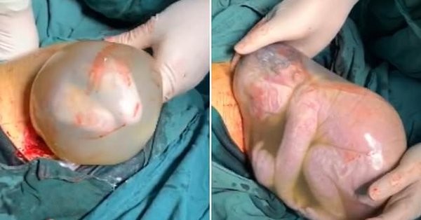 El bebé que nació dentro del saco amniótico y estuvo dos minutos sin respirar | Curiosidades