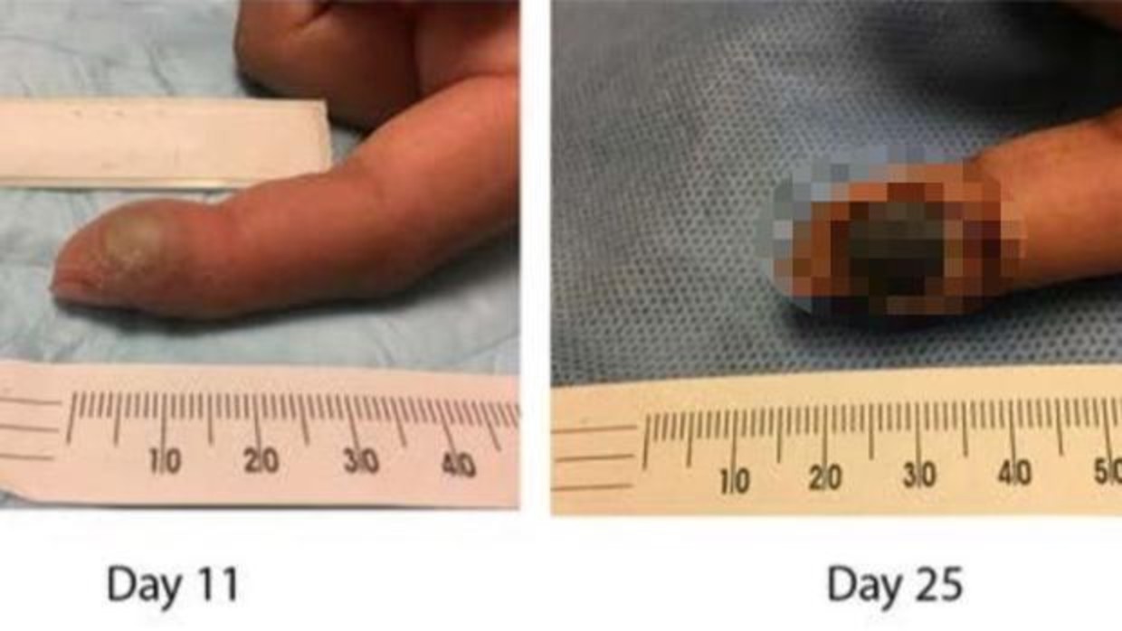 Así le quedó el dedo a una auxiliar de laboratorio que se contagió el virus de la viruela por un pinchazo accidental | Curiosidades