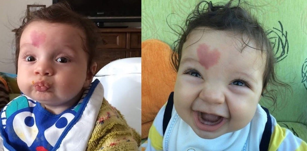 Furor mundial por "Baby Love" el niño que nació con un corazón en la frente | Redes