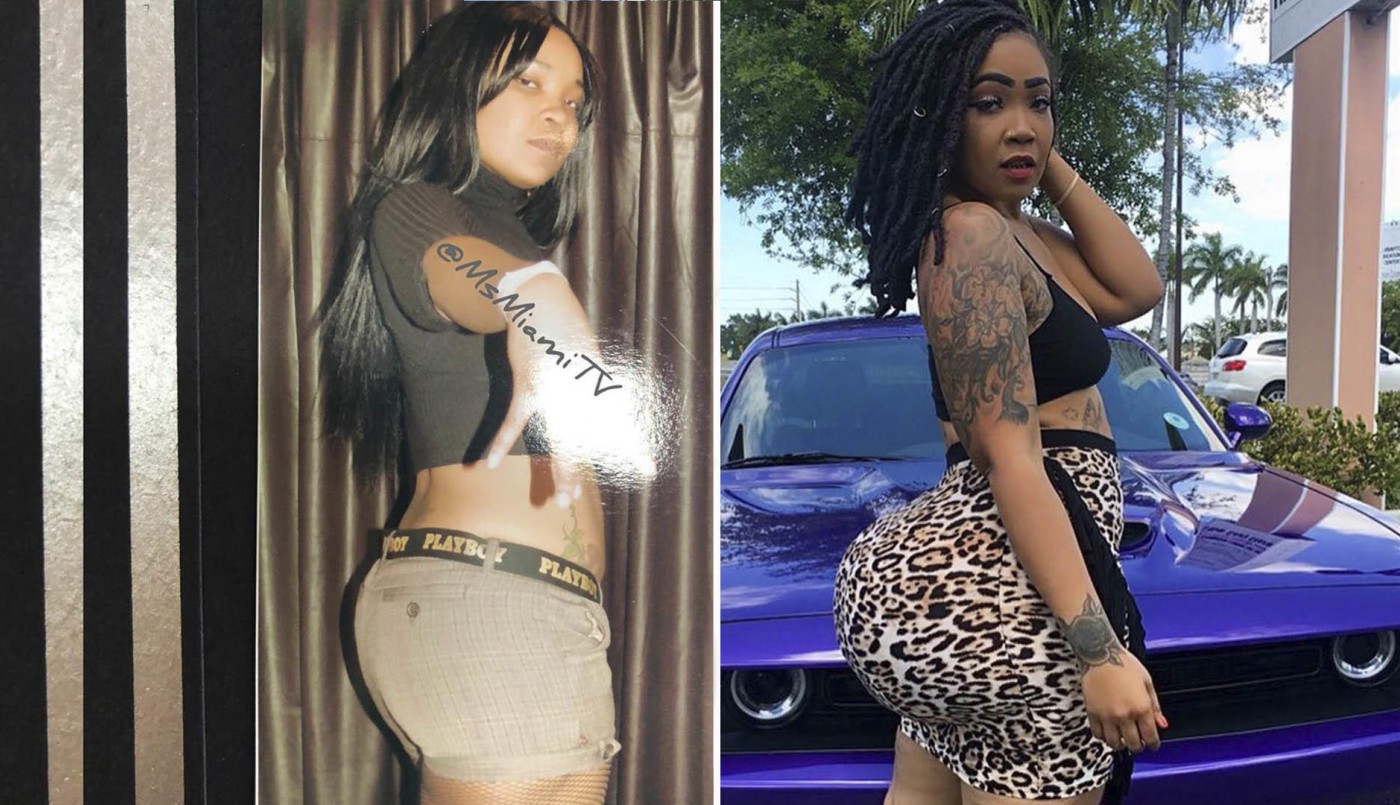 Abusó de las cirugías estéticas y ahora los médicos le advirtieron que tendrán que amputarle los glúteos | Curiosidades