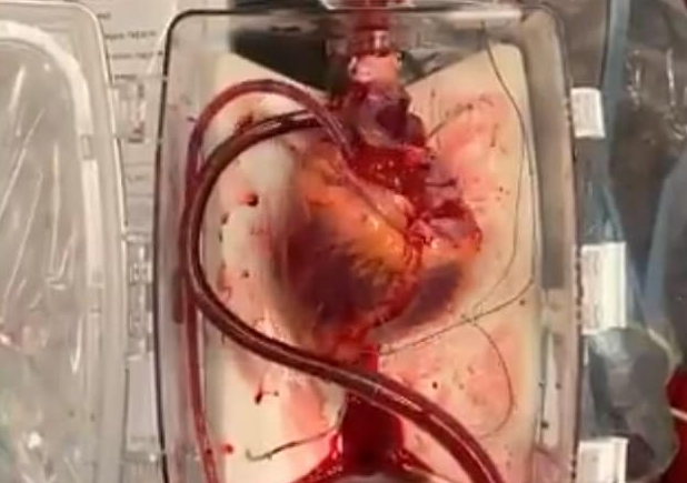 Video: revivieron un "corazón muerto" para usarlo en un trasplante | Internacionales