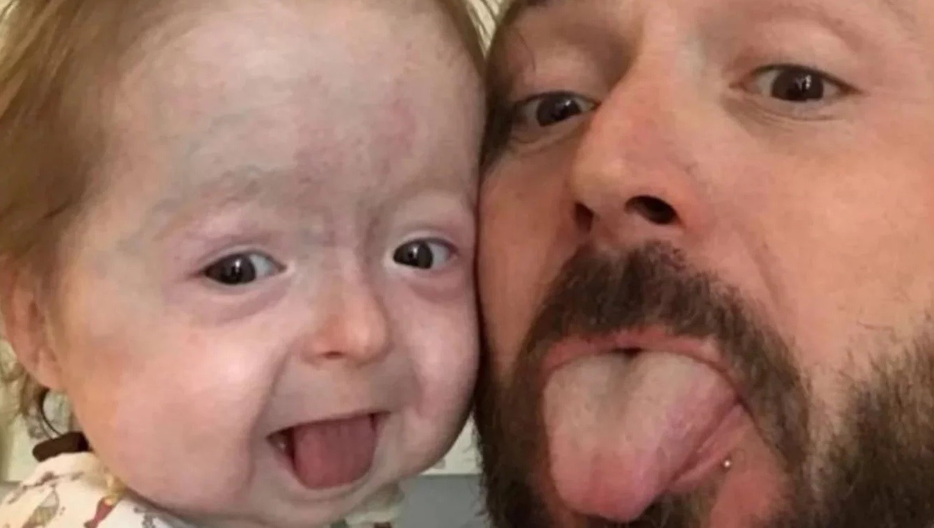 Tiene dos años pero parece anciana por la enfermedad de "Benjamín Button" | Internacionales