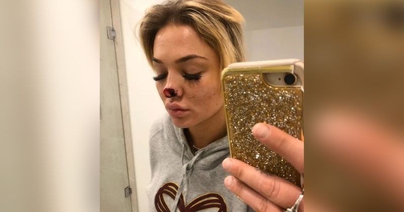 Un hombre le arrancó un pedazo de nariz a su ex novia | Internacionales