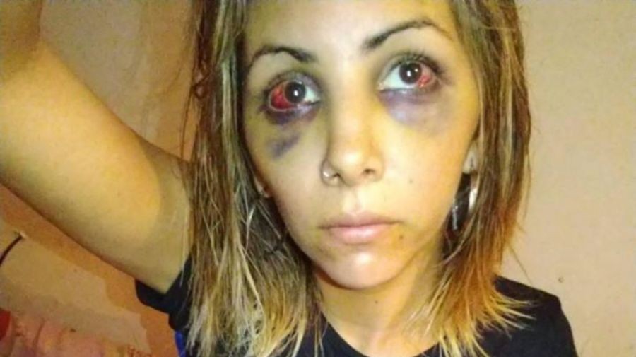 La advertencia de su ex tras desfigurarle la cara: "Agradecé que no te pegué un tiro" | Actualidad