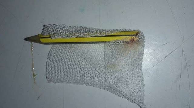 Una nena tuvo clavado un lápiz en el glúteo más de 3 meses | Actualidad