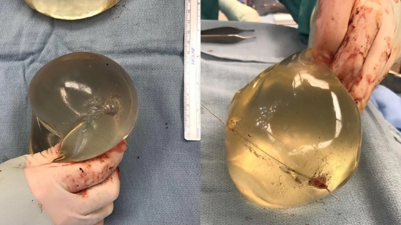 Le dispararon y salvó su vida por los implantes de siliconas que tenía en los pechos | Curiosidades