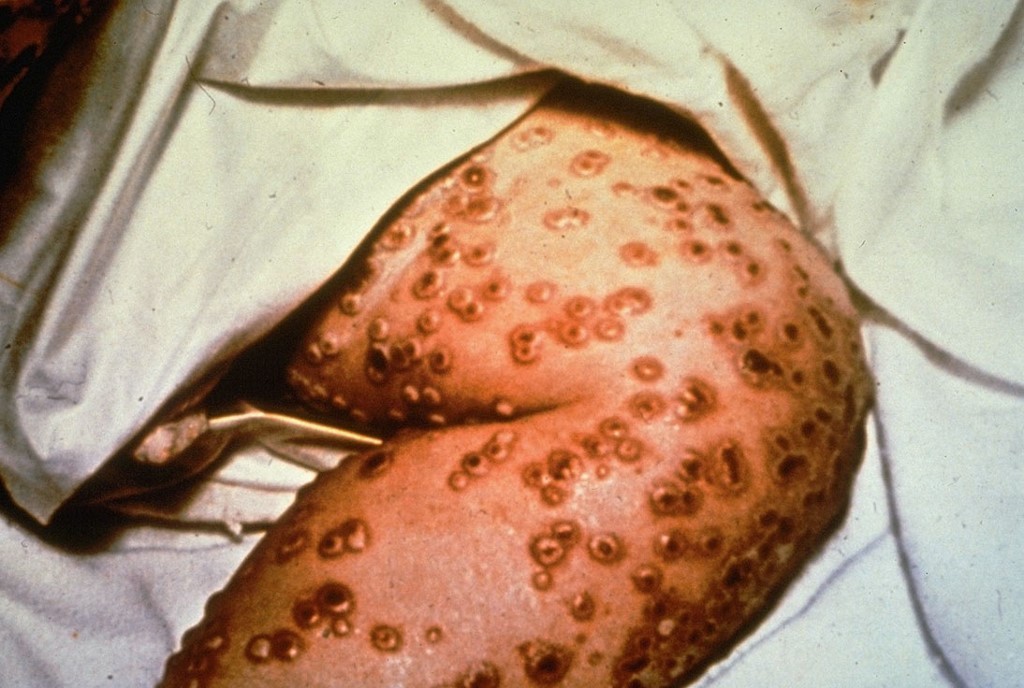 Primer virus erradicado: hace 40 años se declaraba el triunfo sobre la viruela | Actualidad