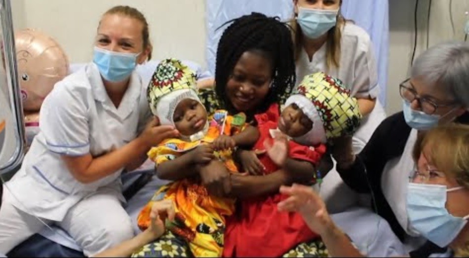 Hazaña médica: separaron a siamesas unidas por la cabeza | Internacionales